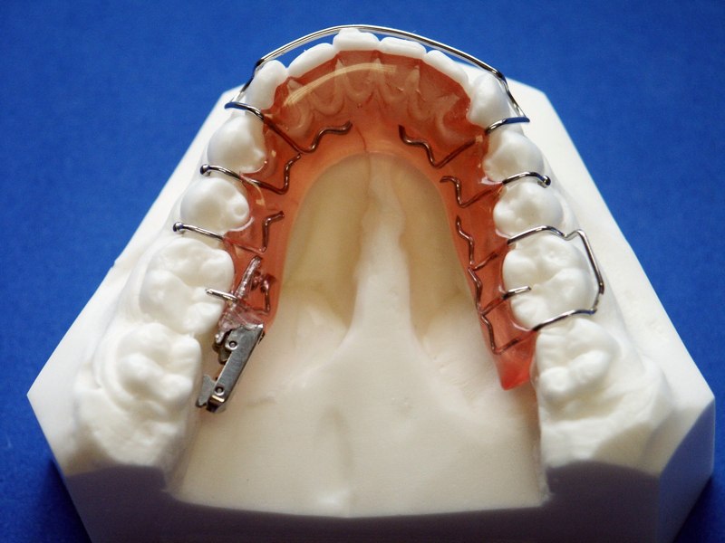 Crossbite Appliance