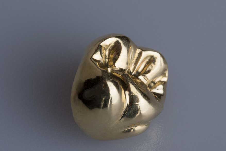 Full Cast Crown Edent Dental Lab Full cast crown edent dental lab