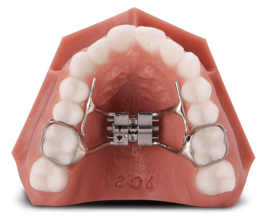 Rapid Palatal Expander