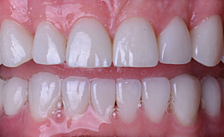 Non-Prep Veneer